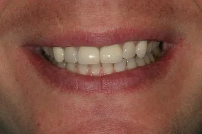 Porcelain Crowns Before