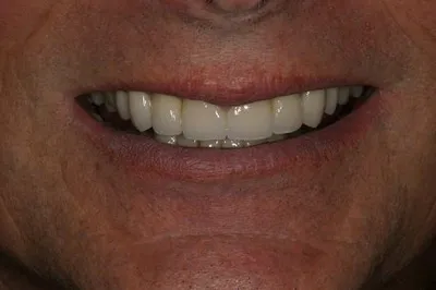 Porcelain Crowns After