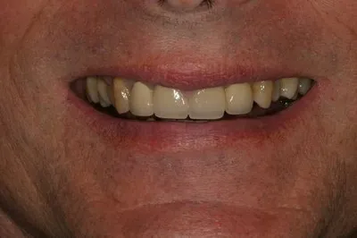 Porcelain Crowns Before