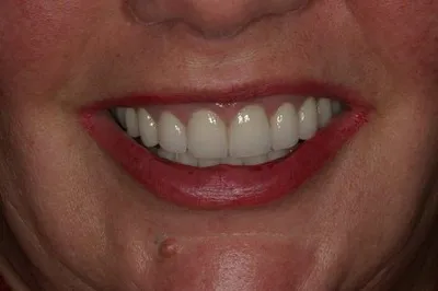 Porcelain Crowns After