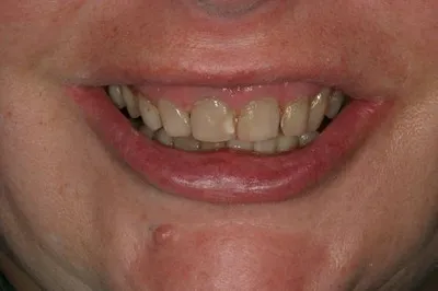 Porcelain Crowns Before