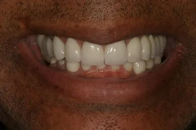 Porcelain Crowns After