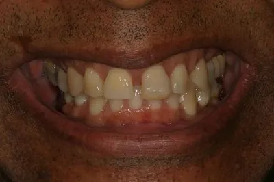 Porcelain Crowns Before