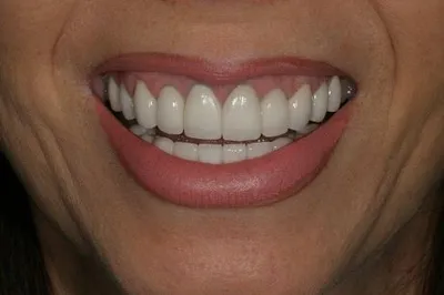 Porcelain Crowns After