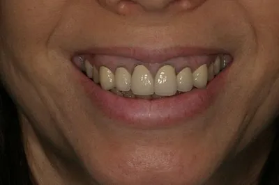 Porcelain Crowns Before