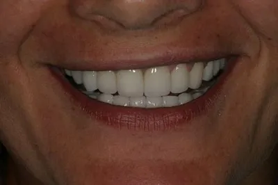 Porcelain Crowns After