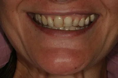 Porcelain Crowns Before