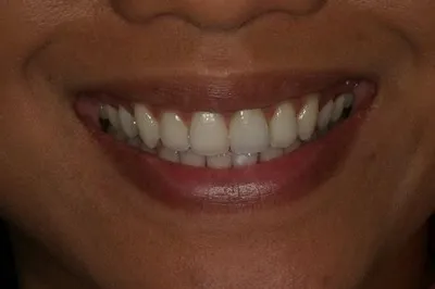 Porcelain Crowns After