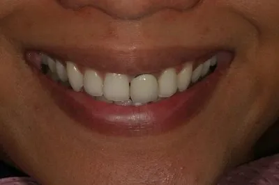 Porcelain Crowns Before