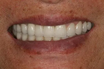 Porcelain Crowns After