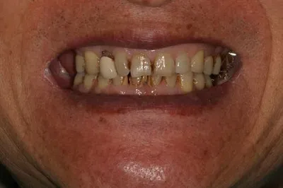 Porcelain Crowns Before