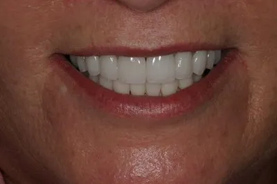 Porcelain Crowns After