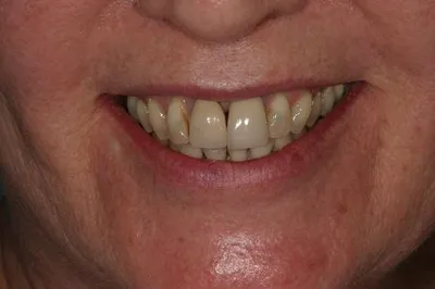 Porcelain Crowns Before