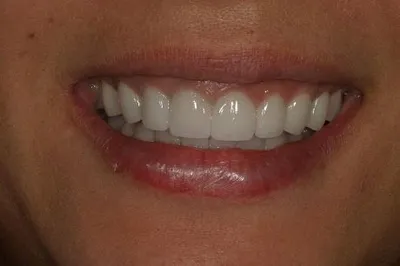 Porcelain Crowns After