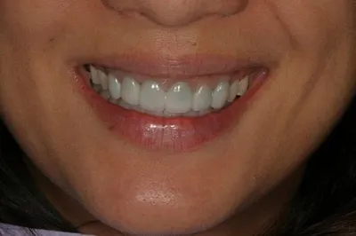 Porcelain Crowns Before