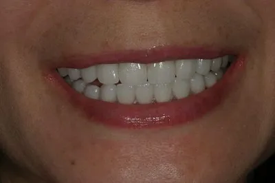 Porcelain Crowns After