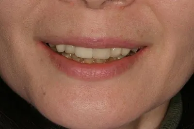 Porcelain Crowns Before