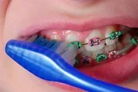 Braces Care - Pediatric dentist in Roxborough, Dresher, Jenkintown, Newtown Square, and Philadelphia, PA.