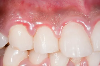 Gum Disease