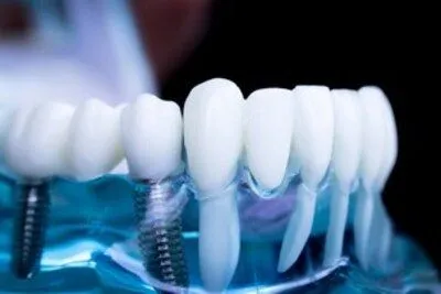 Dental Implants Corona