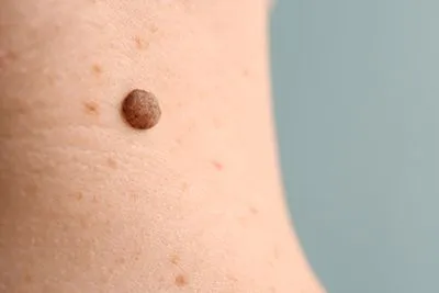 Mole on skin shown in detail, potentially for skin cancer screening