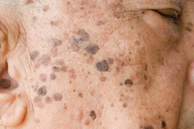 Close-up of age spots on senior man’s cheek