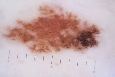 Close-up view of irregular dark mole indicating melanoma.