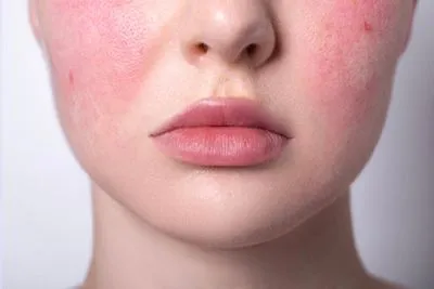 Woman with rosacea