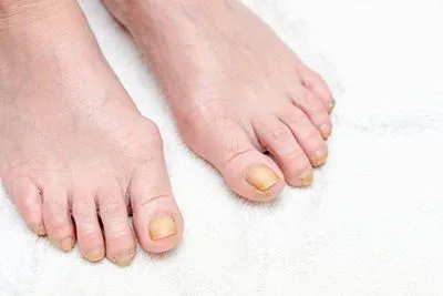 Toenail-Fungus-Treatment-in-Joliet-and-Channahon-IL