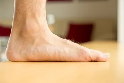Foot affected by flat feet or fallen arches, shown from side view