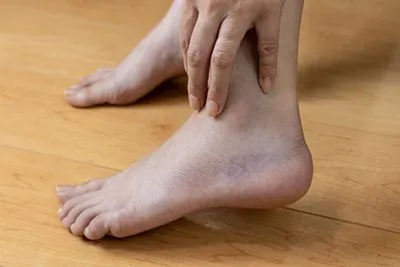 Female patient with a sprained foot and visible mild internal bleeding or bruising.