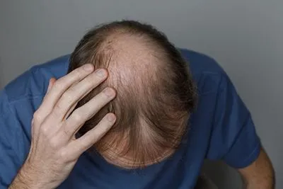 Hair Loss in Tarzana & Simi Valley, CA