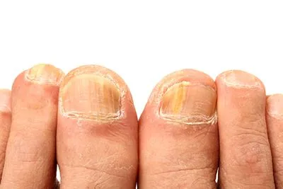 Toenail-Fungus-Treatment-in-Bismarck-ND