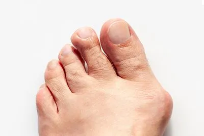 Bunion-Treatment-in-Bismarck-ND