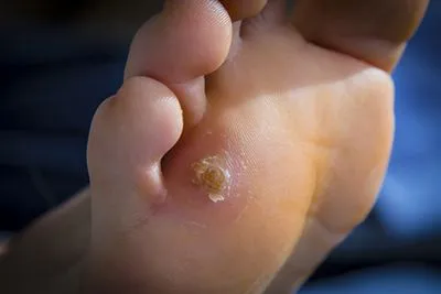 Corn-Treatment-in-Bismarck-ND