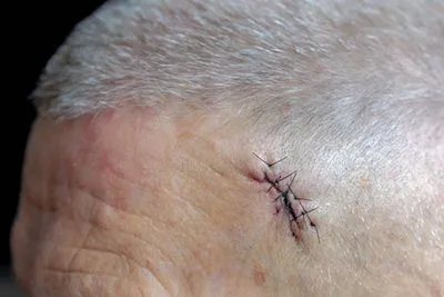 Man after the MOHS Surgery in head