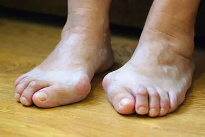 Bunion Treatment in Alexandria, VA