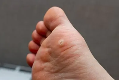 Warts-Treatment-in-Alexandria-VA