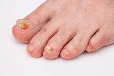 Fungal-Toenail-Treatment-in-Austin-Buda-and-Kyle-TX