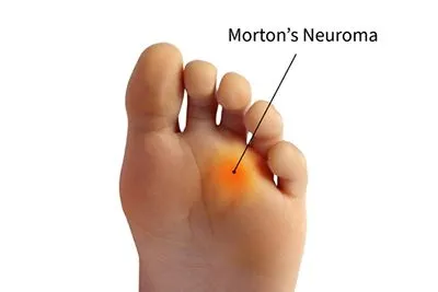 Morton's Neuroma