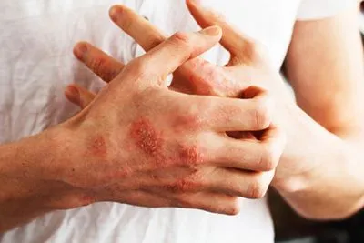 Illustration of eczema on skin
