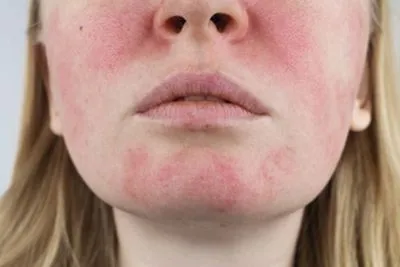 Female patient with facial redness and rosacea flare-ups on cheeks.