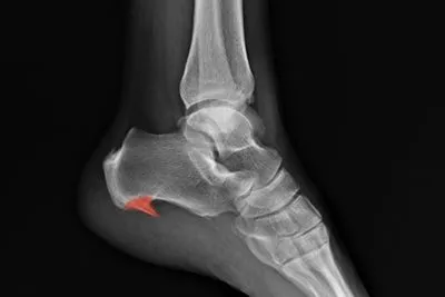 X-ray image showing heel spurs highlighted in red