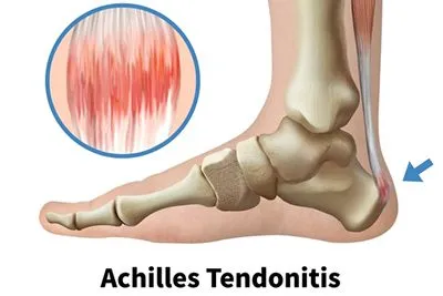 Achilles Tendonitis