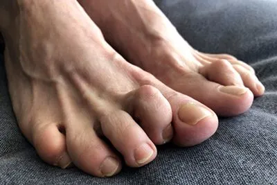 Hammertoe-Treatment-in-Ashland-KY