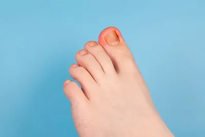 Ingrown-Toenail-Treatment-in-Ashland-KY
