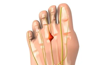 Neuroma-Treatment-in-Ashland-KY