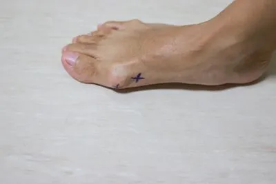 Bunion condition