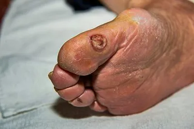 Close-up of foot ulcer located beneath the toenail
