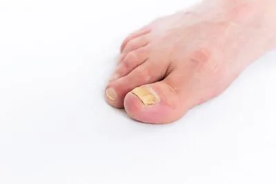 Nail Fungus on aperson foot